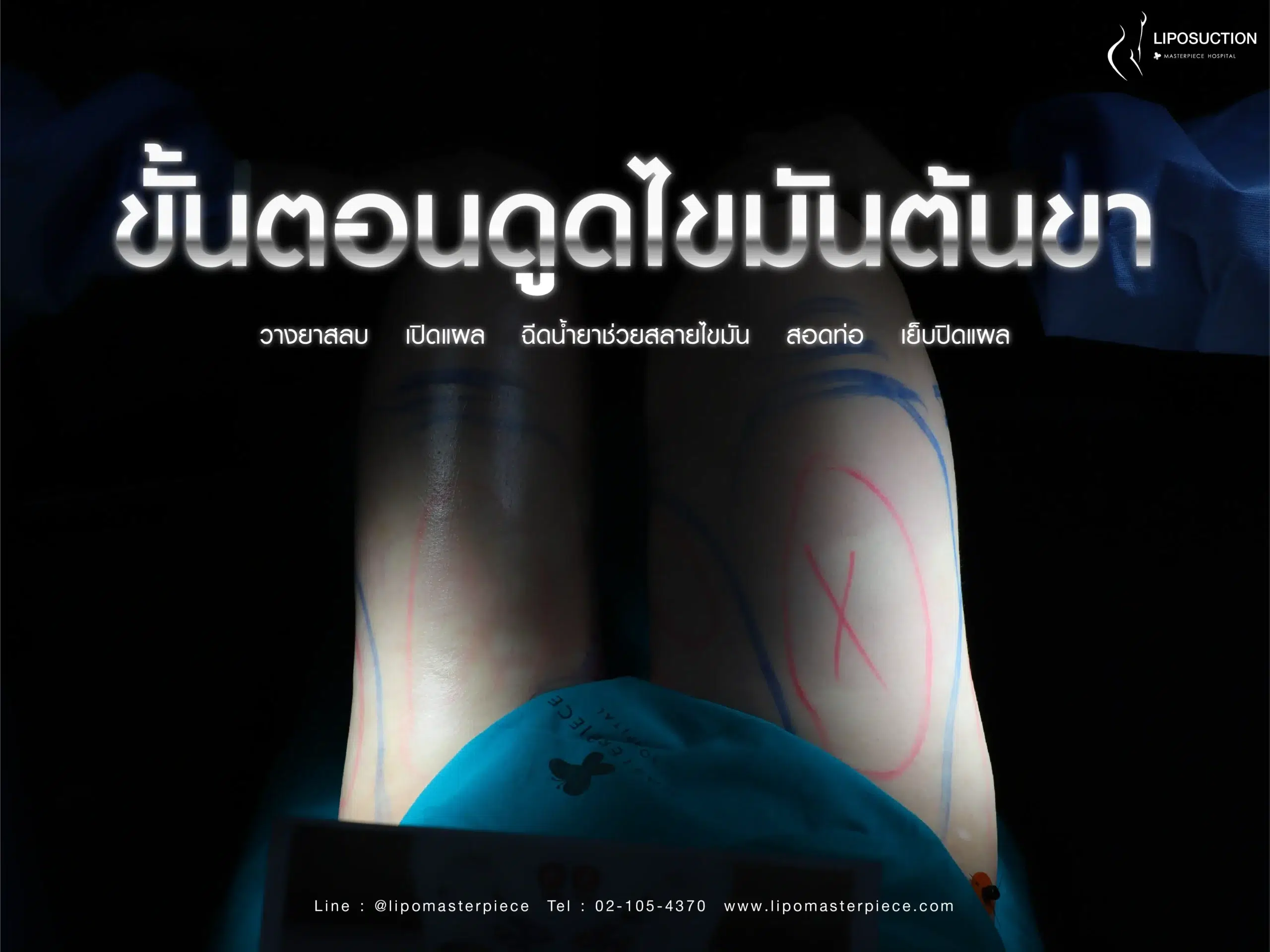 ขั้นตอนการทำการดูดไขมันต้นขา