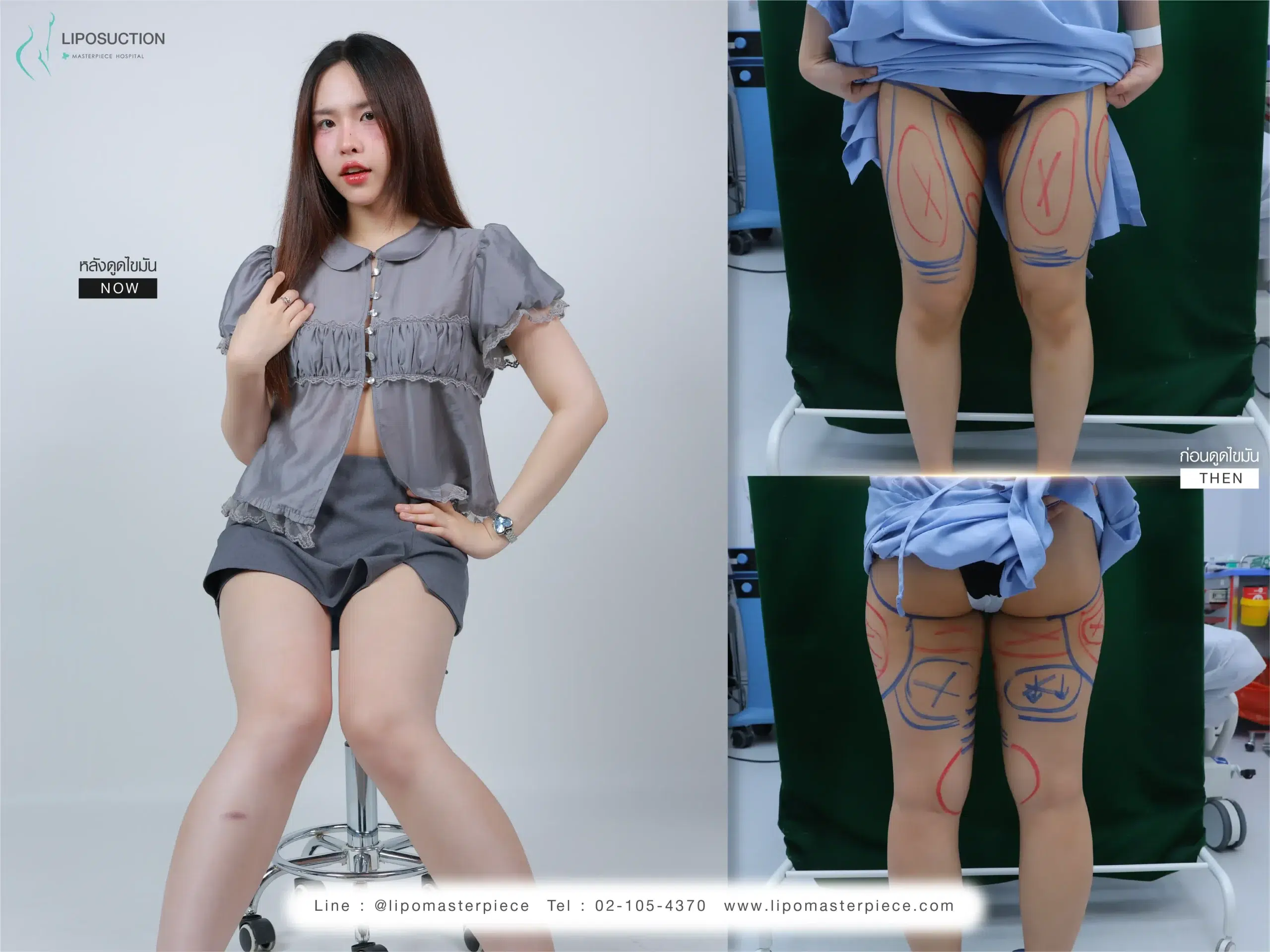 ข้อควรปฏิบัติหลังดูดไขมันต้นขา