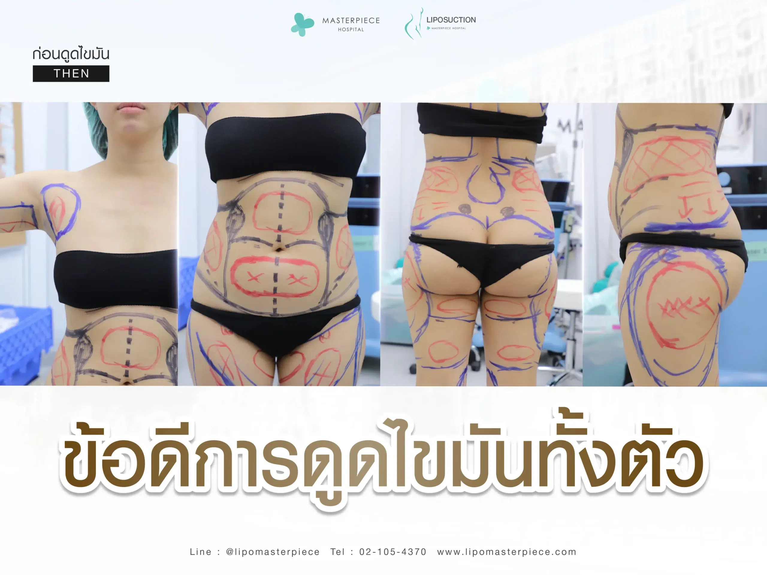 ข้อดีของการดูดไขมันทั้งตัว