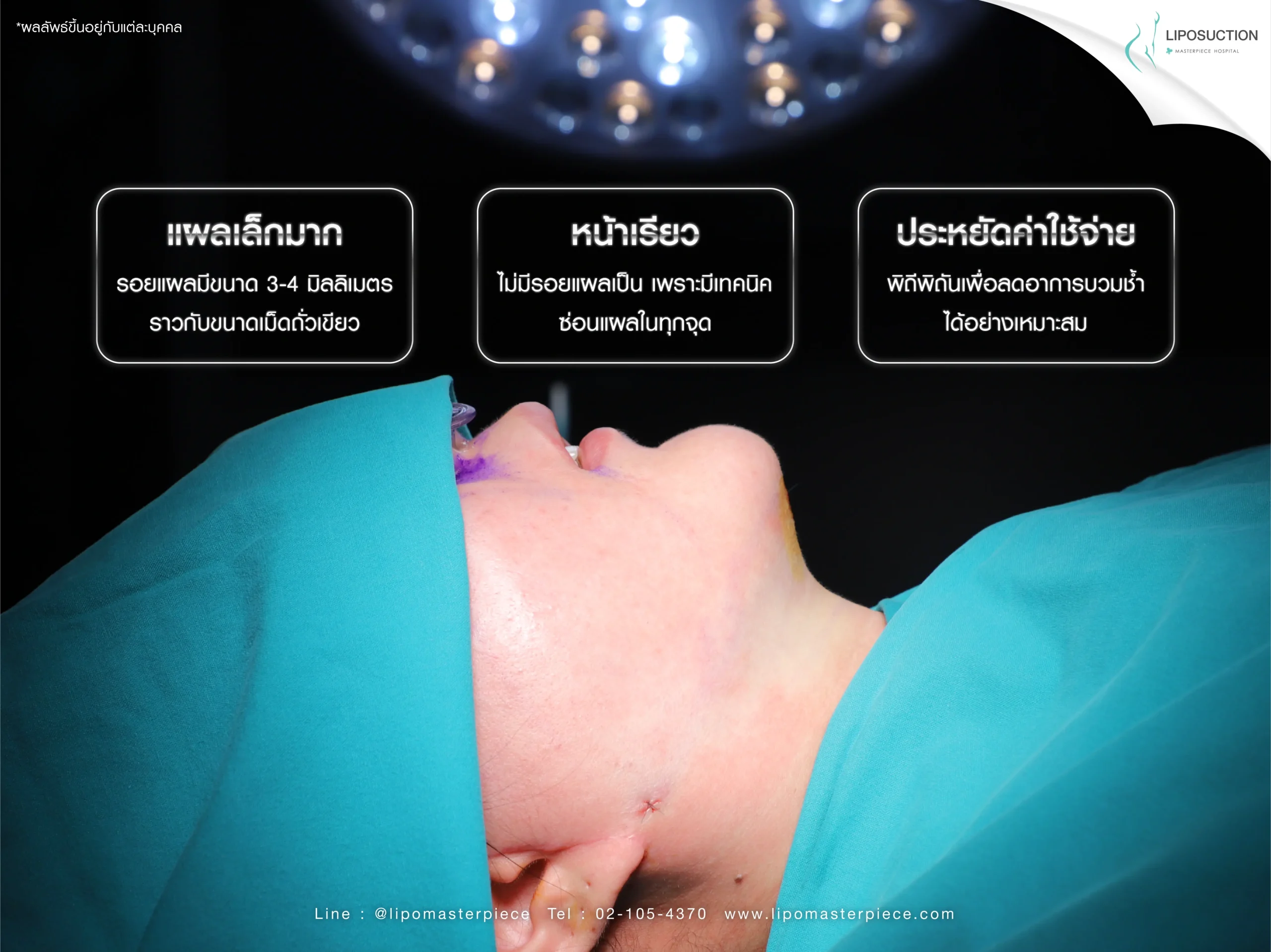 เทคนิคการดูดไขมันแก้ม