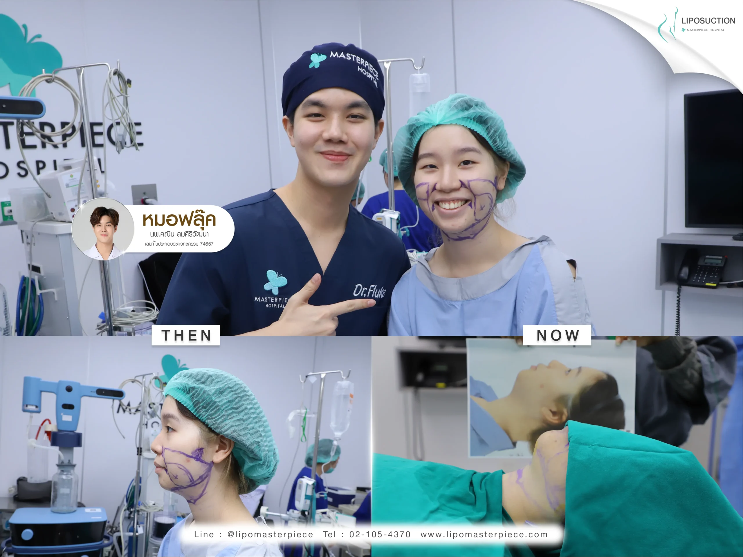 การดูแลหลังดูดไขมันแก้ม
