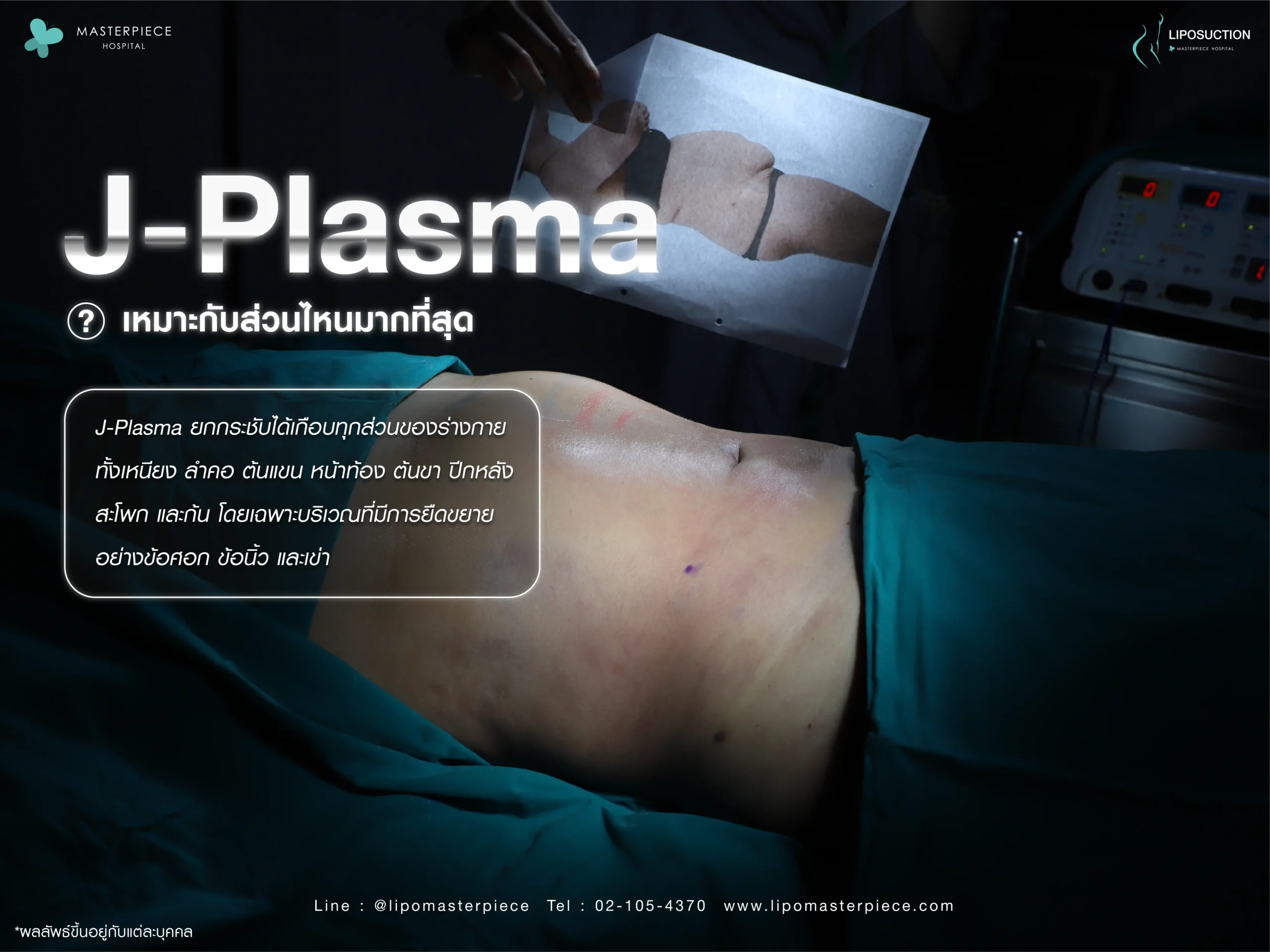 ทำ J Plasma เหมาะกับส่วนไหนมากที่สุด