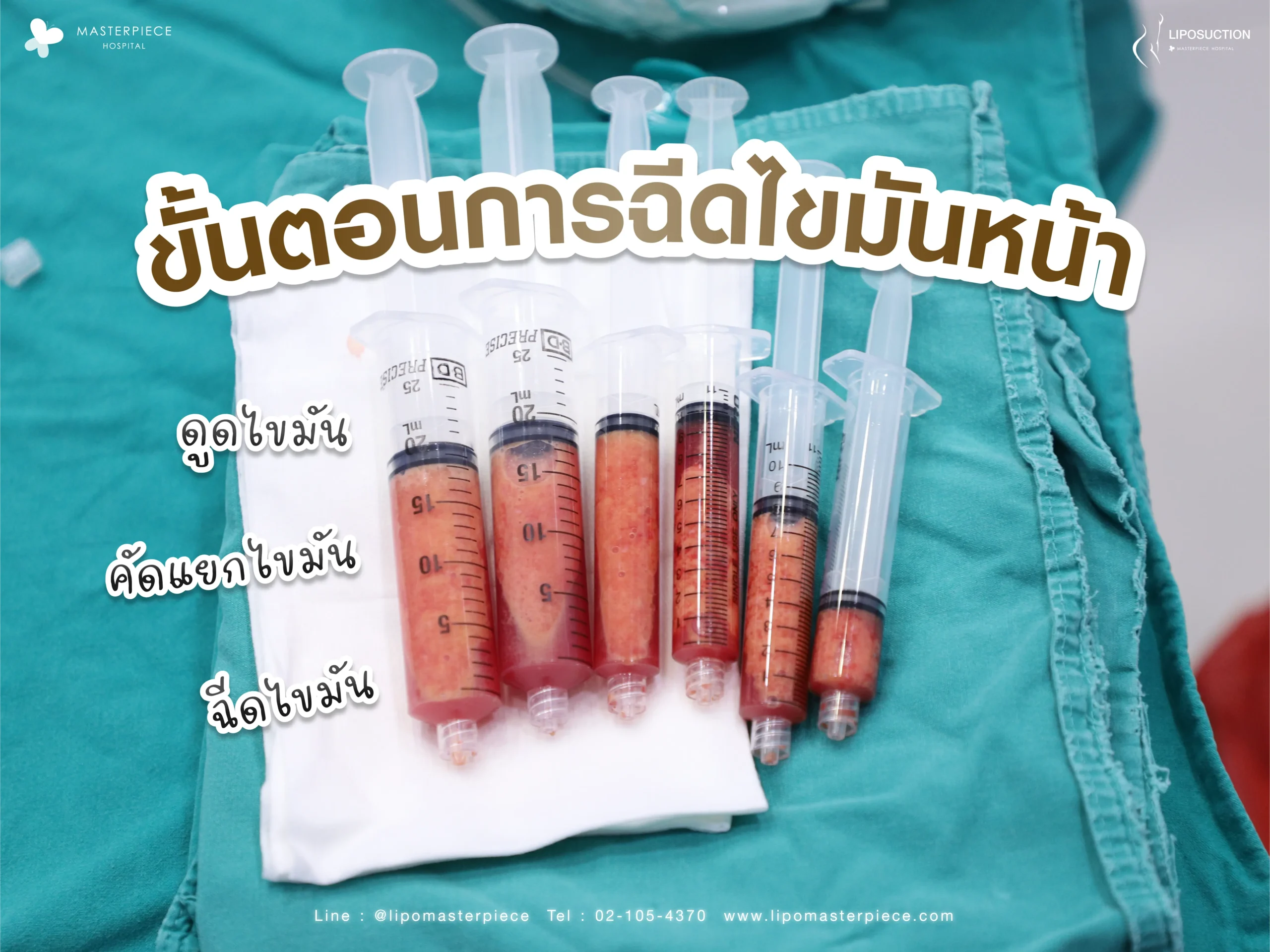 ขั้นตอนการฉีดไขมันหน้า