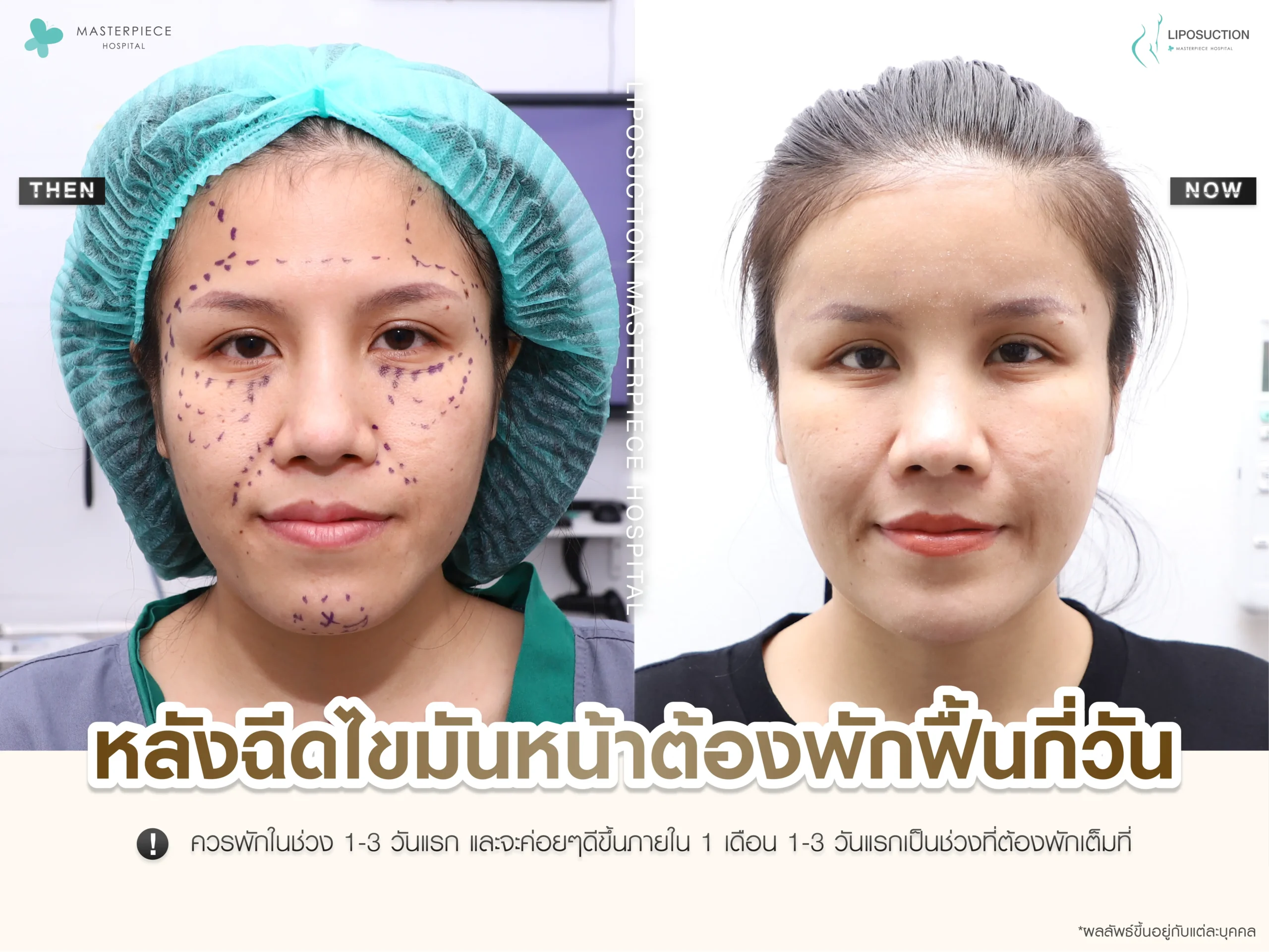 หลังฉีดไขมันหน้าต้องพักฟื้นกี่วัน