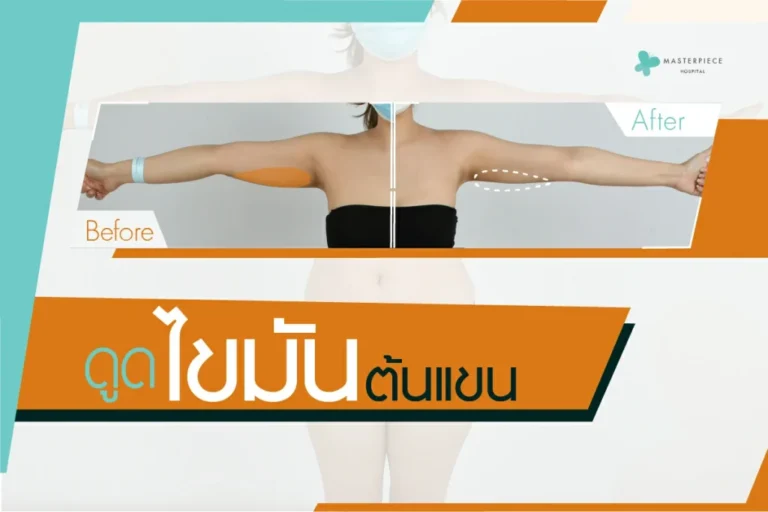 ดูดไขมันต้นแขน