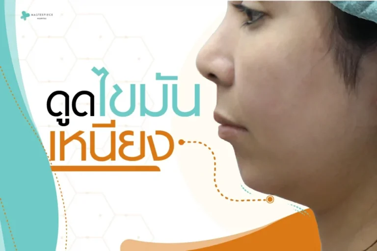 ดูดไขมันเหนียง