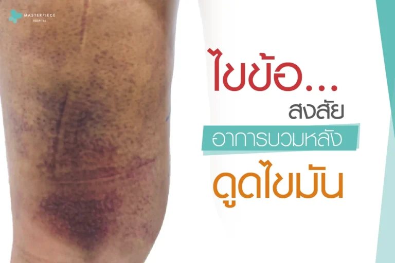 ไขข้อ…สงสัยอาการบวมหลังดูดไขมัน
