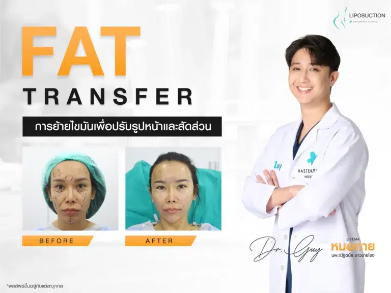 Fat Transfer การย้ายไขมันเพื่อปรับรูปหน้าและสัดส่วน
